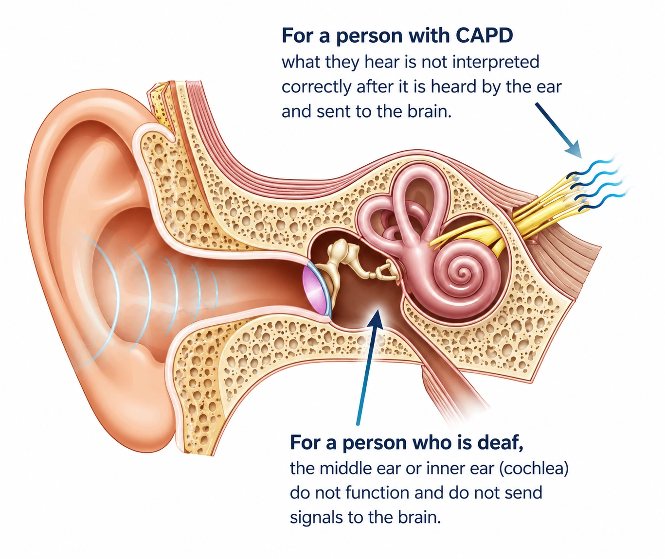 Diagram showing how CAPD affects hearing and sound interpretation